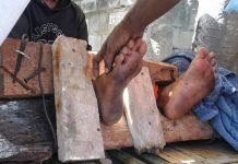 Akibat di PASUNG kaki nya busuk dan lumpuh